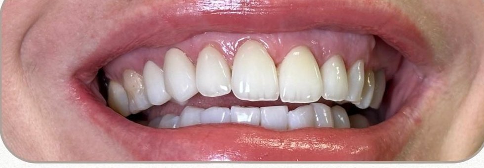 Après – Hollywood Smile